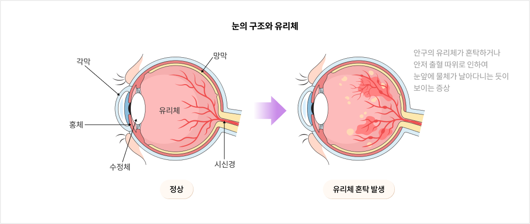 눈의 구조와 유리체